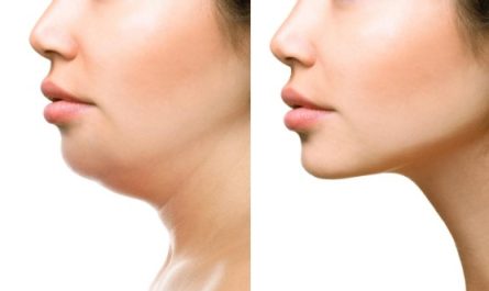 What Is Kybella?